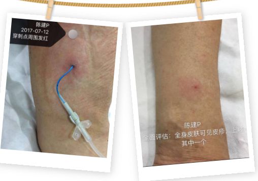 水膠體敷料不止用于壓力性損傷 解鎖皮膚外用敷料的無限可能